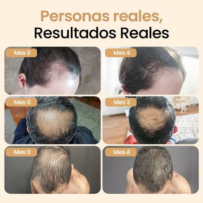 Activador capilar con células madre de capilia longa, factores de crecimiento - Pague 2, lleve 3